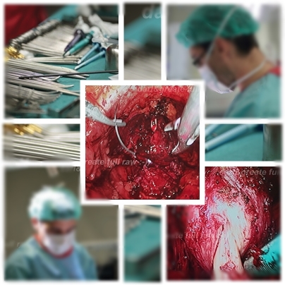 laparoscopia en próstata